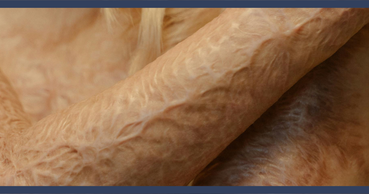 Elgin Burn Injury Lawyer